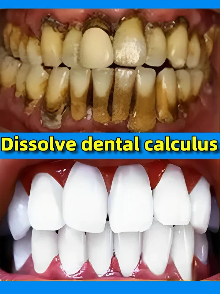 remover dental calculus whitening teeth mouth odor removal bad breath Preventing Periodontitis