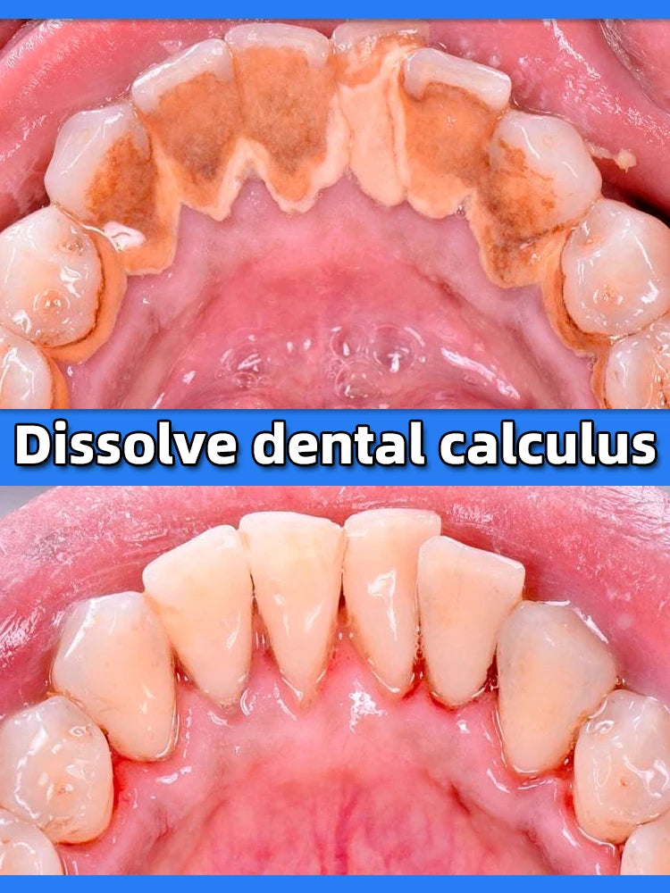 remover dental calculus whitening teeth mouth odor removal bad breath Preventing Periodontitis