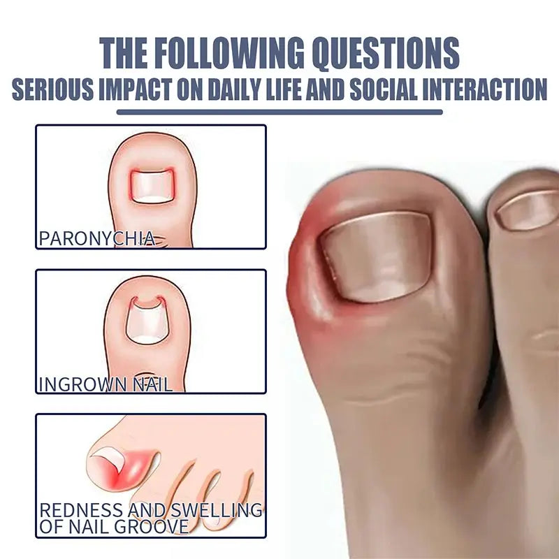 Fungal Nail Laser Device Repair Fast Nails Fungus Onychomycosis Anti Thyroiditis Relief Pure Natural Oil Foot Care Beauty Health