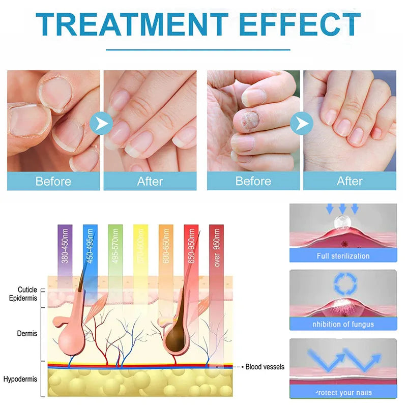 Fungal Nail Laser Device Repair Fast Nails Fungus Onychomycosis Anti Thyroiditis Relief Pure Natural Oil Foot Care Beauty Health